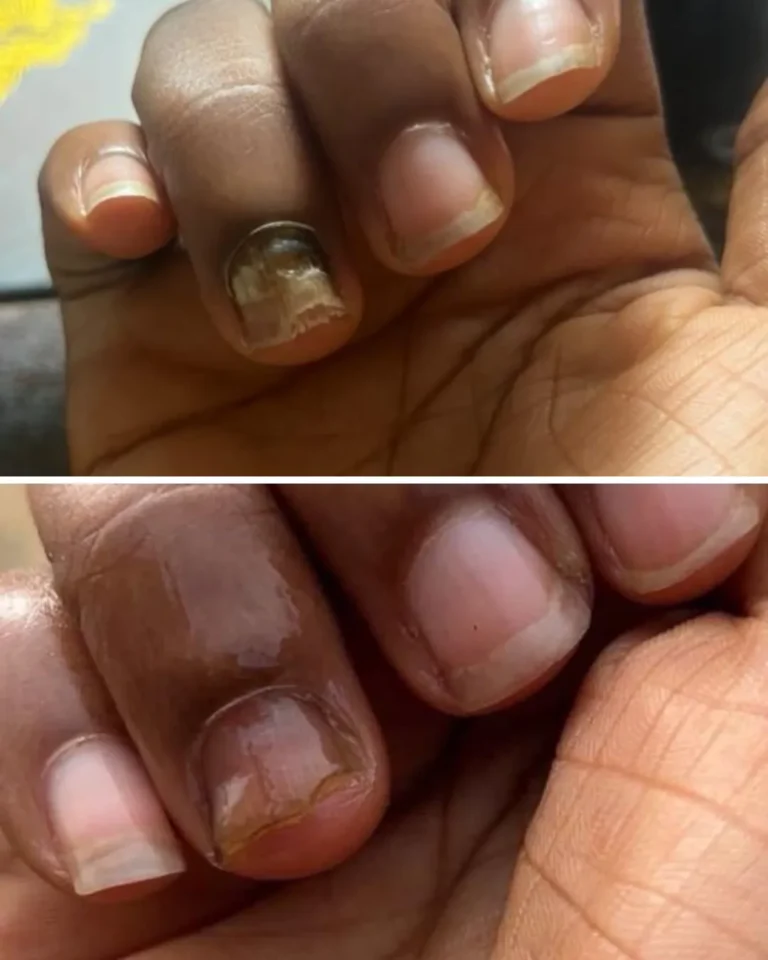Discolored Nails Treatment Products in Nigeria