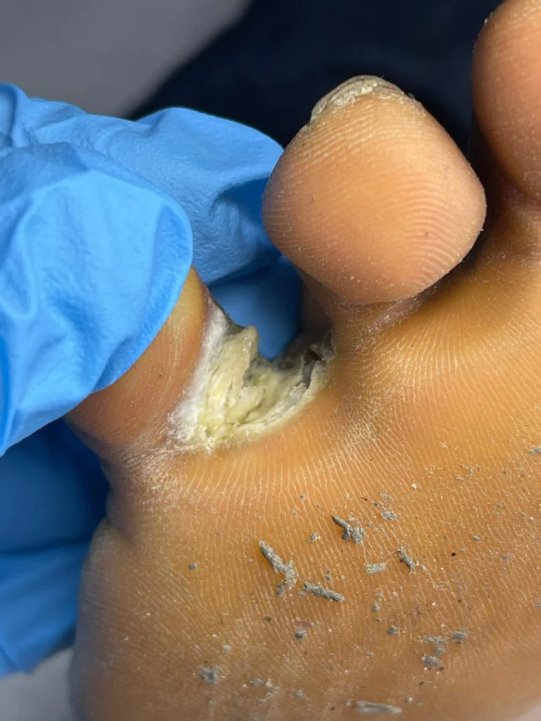 Top Fungal Nail Infection Treatment Products in Nigeria (2026 Buyer’s Guide)